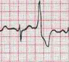 Příznaky srdeční arytmie