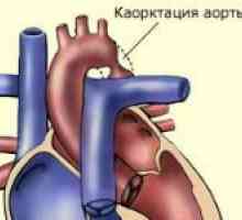 Koarktace aorty a její léčba