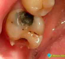 Bolest zubů pro dočasné výplně: Potřebujete bít na poplach