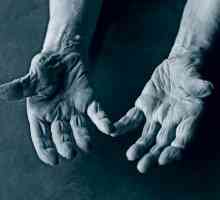 Bolesti kloubů prstů: léčba a prevence