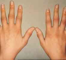 Běžné příčiny otoky prstů