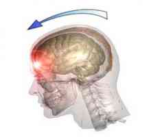 Traumatické poranění mozku (TBI), poranění hlavy: příčiny, typy, příznaky, léčba