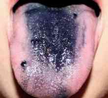 Černý jazyk u člověka: důvody, proč tam je černý povlak na jazyku