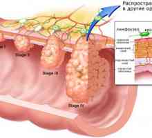 Typy, příznaky a léčba nádorů žaludku
