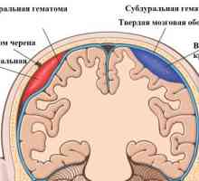 Příznaky a léčba epidurální hematom mozku