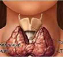 Co je Hashimotova tyroiditida štítné žlázy, cimptomy a léčení nemocí