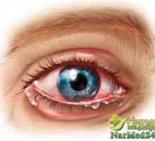 Co je iridocyklitidy očí a jak se vypořádat s nemocí