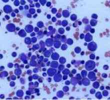 Leukocytóza (zvýšené množství bílých krvinek v krvi): normy nebo patologii?