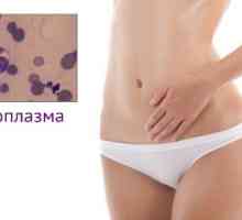 Příznaky a léčba Mycoplasma gominis