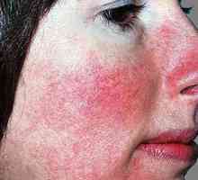 Co je růžovka nebo akné rosacea: příčiny, příznaky, prevence