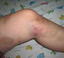 Co je zranění nohy, a zejména její léčba