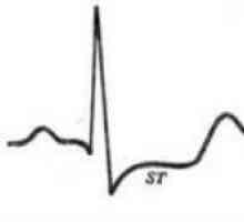 EKG známky srdeční angínou