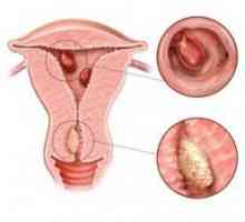 Co je glandulocystica hyperplazie endometria