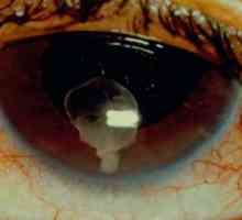Cysticerkóza očí: příčiny, příznaky, léčba