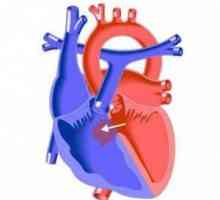 Srdeční vada interventricular septa (VSD): příčiny, příznaky, léčba