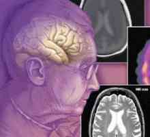 Demenci (demence): symptomy, léčba, způsobuje senilní, cévní