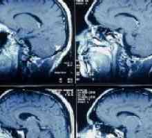 Diagnostické schopnosti mozkových cév MRI