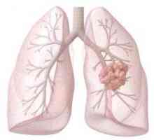 Diagnostika a léčba rakoviny plic