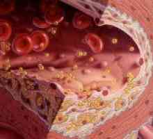 Diagnostika a známky aterosklerózy