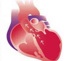 Dilatace srdečních komor, aorta - podmínky, příznaky, diagnostika, léčba