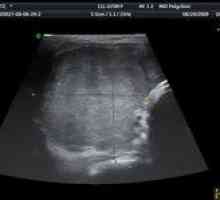 Proč ultrazvuk štítné žlázy, a to ukazuje,
