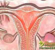 Správná léčba ovariální mrtvice lidových prostředků