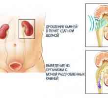 Fragmentace ledvinových kamenů s ultrazvukem