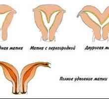 Dva-horned děloha: struktura anomálií genitálií