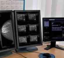 Rakoviny prsu Fibroadenom: příčiny, příznaky, indikace k odstranění
