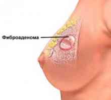 Fibroadenom prsu - co to je a jak se toho zbavit?