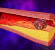 Tromboflebitida hlubokých žilách dolních končetin a jejich léčení