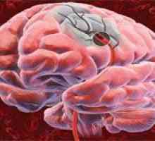 Důsledky ischemické cévní mozkové příhody mozkové