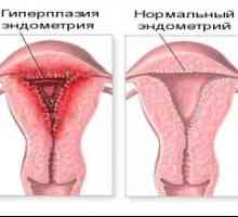 Hyperplazie endometria: léčba léky a lidových prostředků