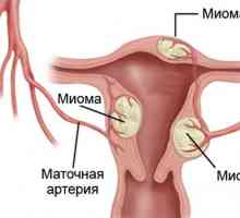 Hyperplazie rakovina endometria