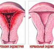 Hyperplazie endometria během menopauzy