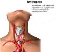 Hypotyreóza. Příznaky a léčba