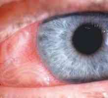 Oční larvální toxokaróza: symptomy, diagnostika, léčba