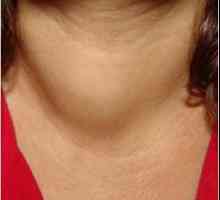 Hashimotova tyroiditida s výsledkem hypotyreózy: příznaky a léčba
