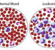 Jak se k léčbě leukémie krve