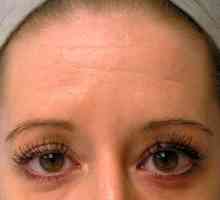 Botox proti vráskám na čele