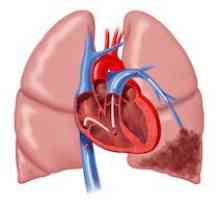 Plicní myokardu: příčiny, příznaky, jak se chovat, účinky