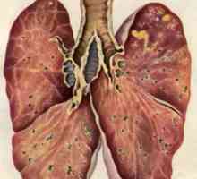 Inkubační doba tuberkulózy, jeho diagnóze a léčbě