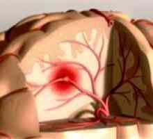 Hlavními příznaky cévní mozkové příhody