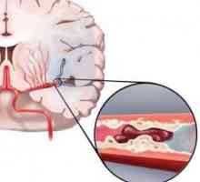 Cévní mozková příhoda: příčiny, příznaky, první pomoc, léčba, komplikace, prognóza