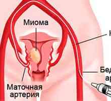 Účinná léčba fibroidy malé velikosti dělohy
