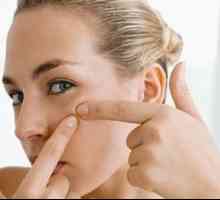 Efektivní a levná akné mast na obličej - na co se zaměřit?