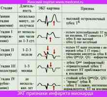 EKG příznaky infarktu myokardu. Obrázky a vysvětlení