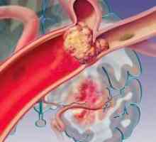 Cévní embolie, arteriální: Typy, příznaky, léčba, prevence
