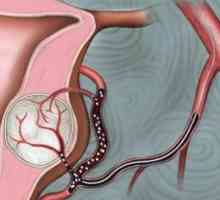 Embolizace děložních myomu tepen: důkaz, postup, výsledky