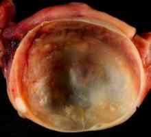 Endometria ovariální cysty